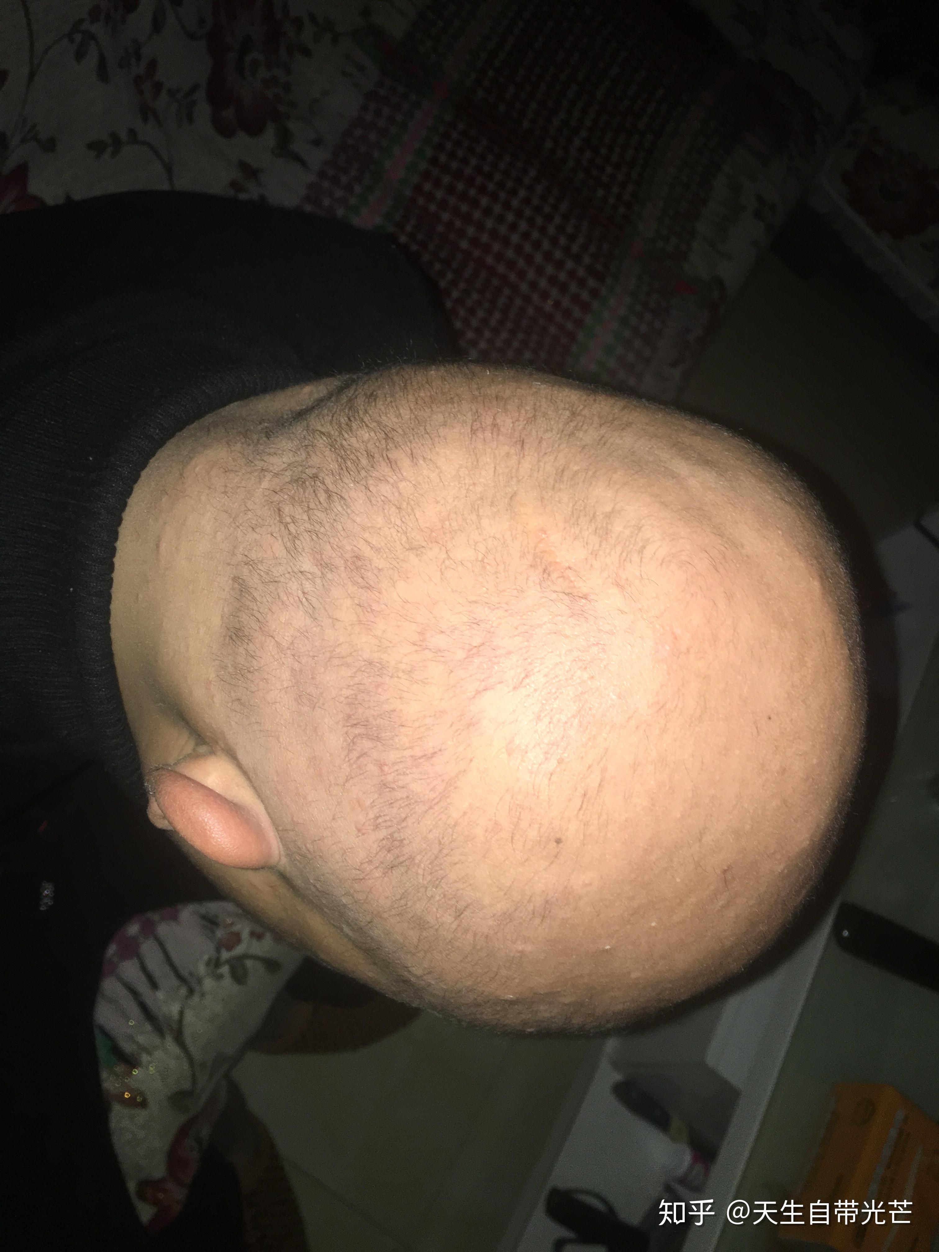 一名普秃男的恢复