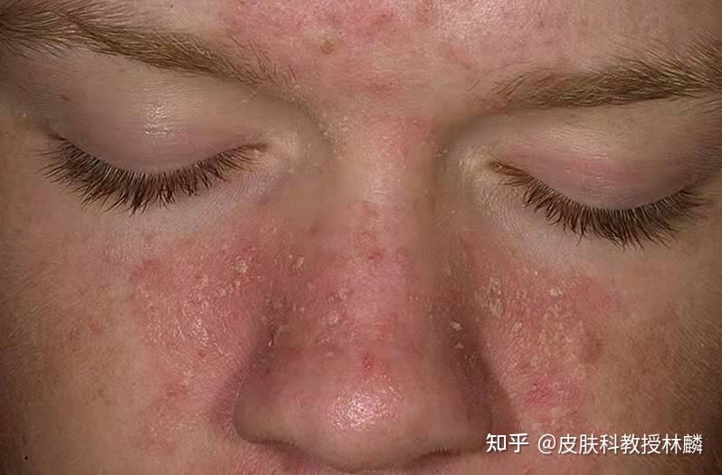 鼻翼两侧发红油腻这个方法简单有效