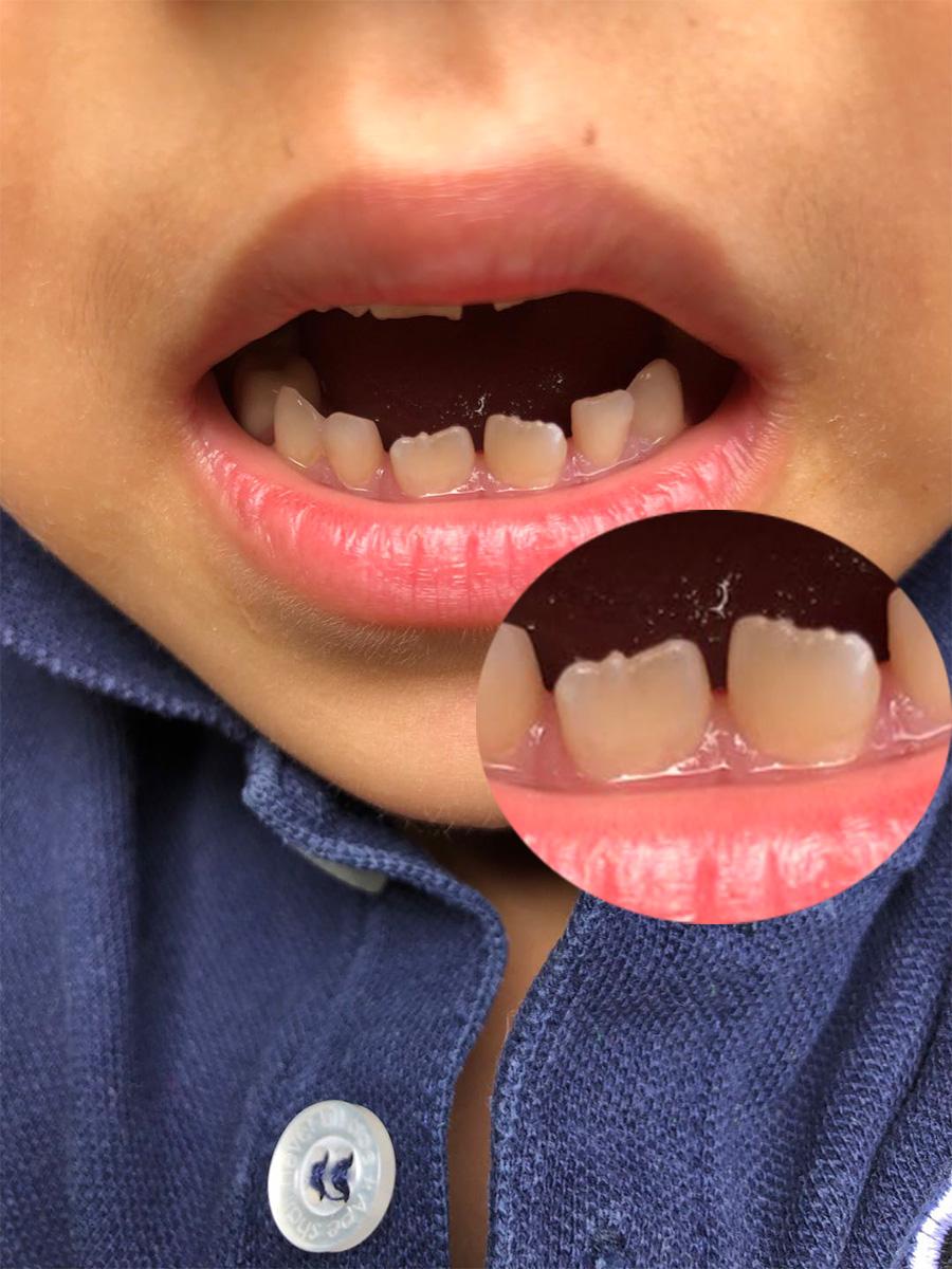 儿童锯齿状牙齿图片