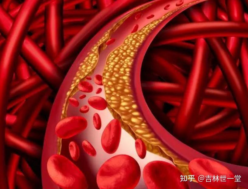高血糖是怎么伤血管的？ - 知乎