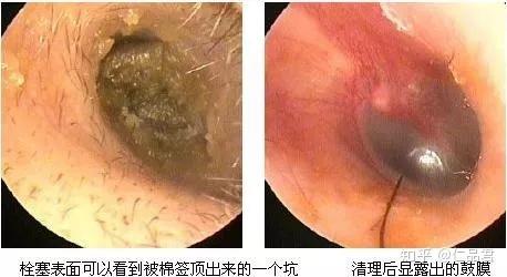 另外,有些木杆棉签做工低劣,掏耳朵时容易出现棉球掉落,杆部折断在外