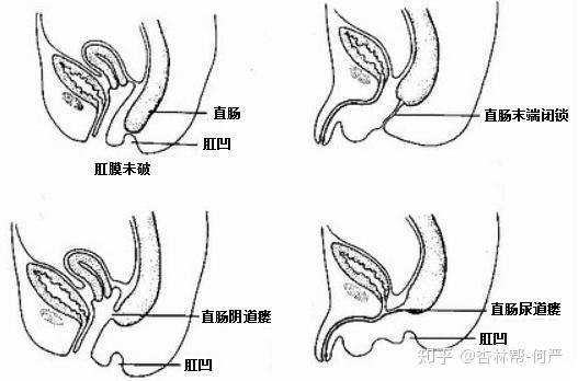 肛门闭锁常见问题解答 下 小儿外科专家王勇科普系列 知乎