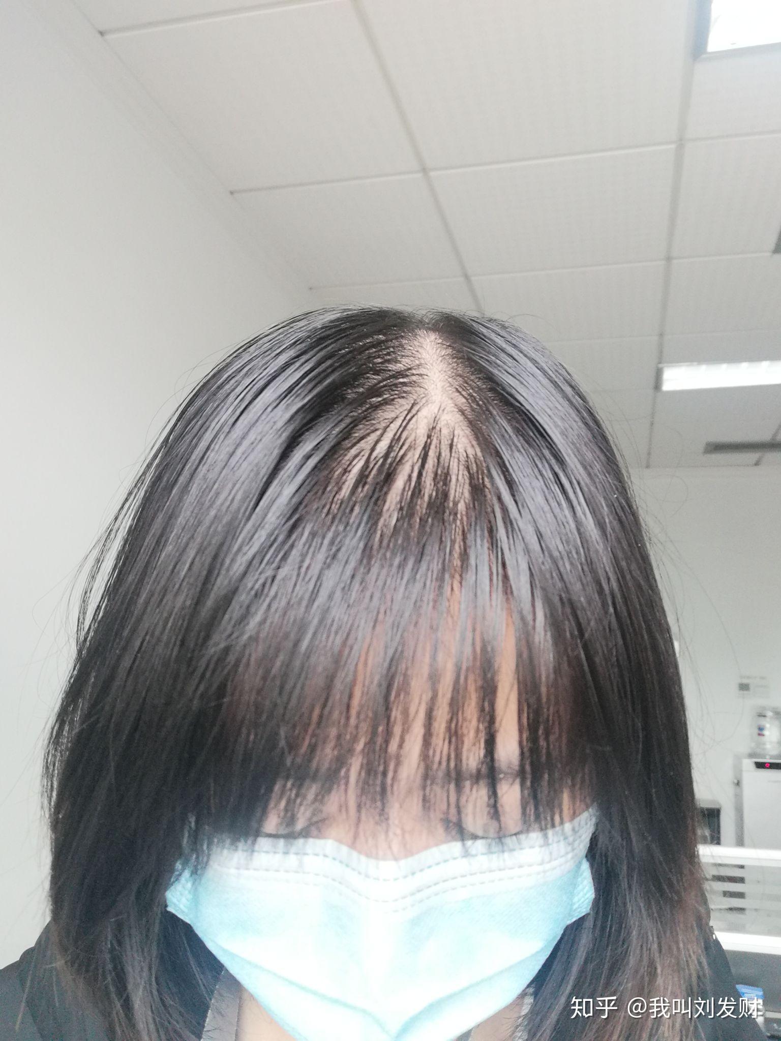 女性23岁脱发秃顶被人笑话想死我应该怎么办