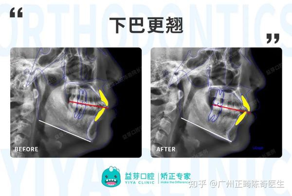 【正畸美学】揭秘“笑线”给笑容带来的变化！一起解锁自信笑容 - 知乎