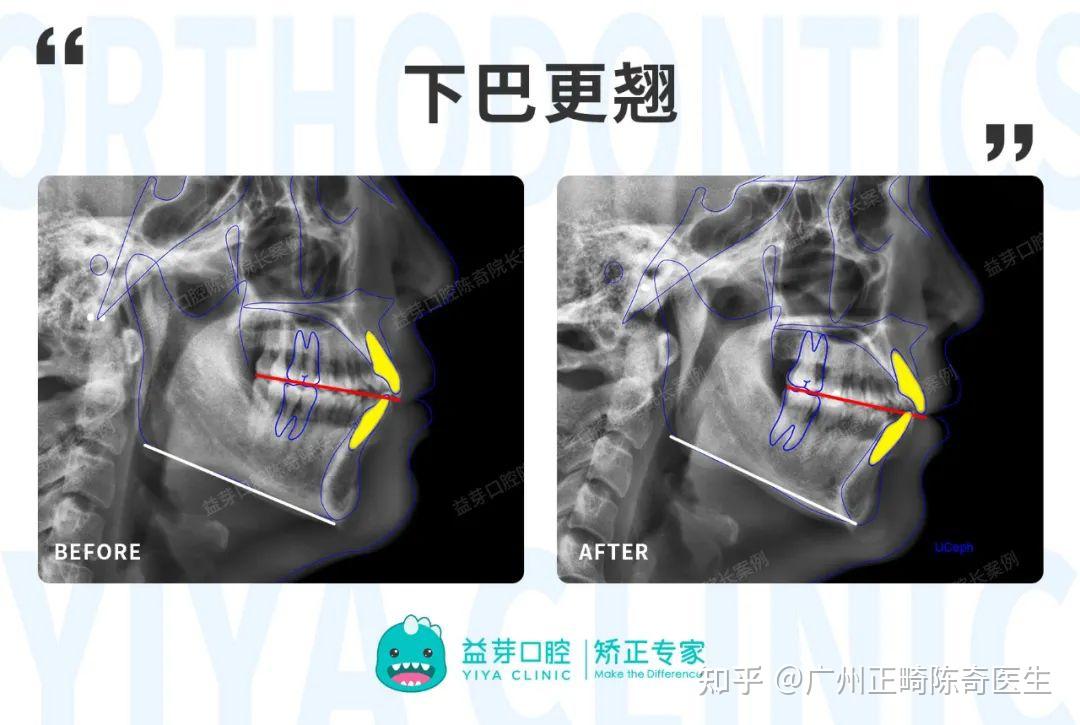 【正畸美学】揭秘“笑线”给笑容带来的变化！一起解锁自信笑容 - 知乎