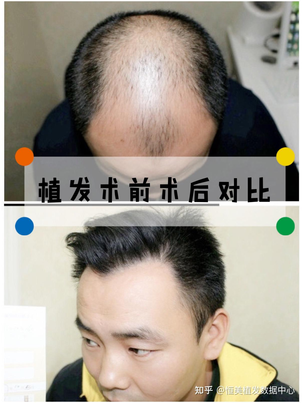 镇远植发(植发在哪里做比较好)