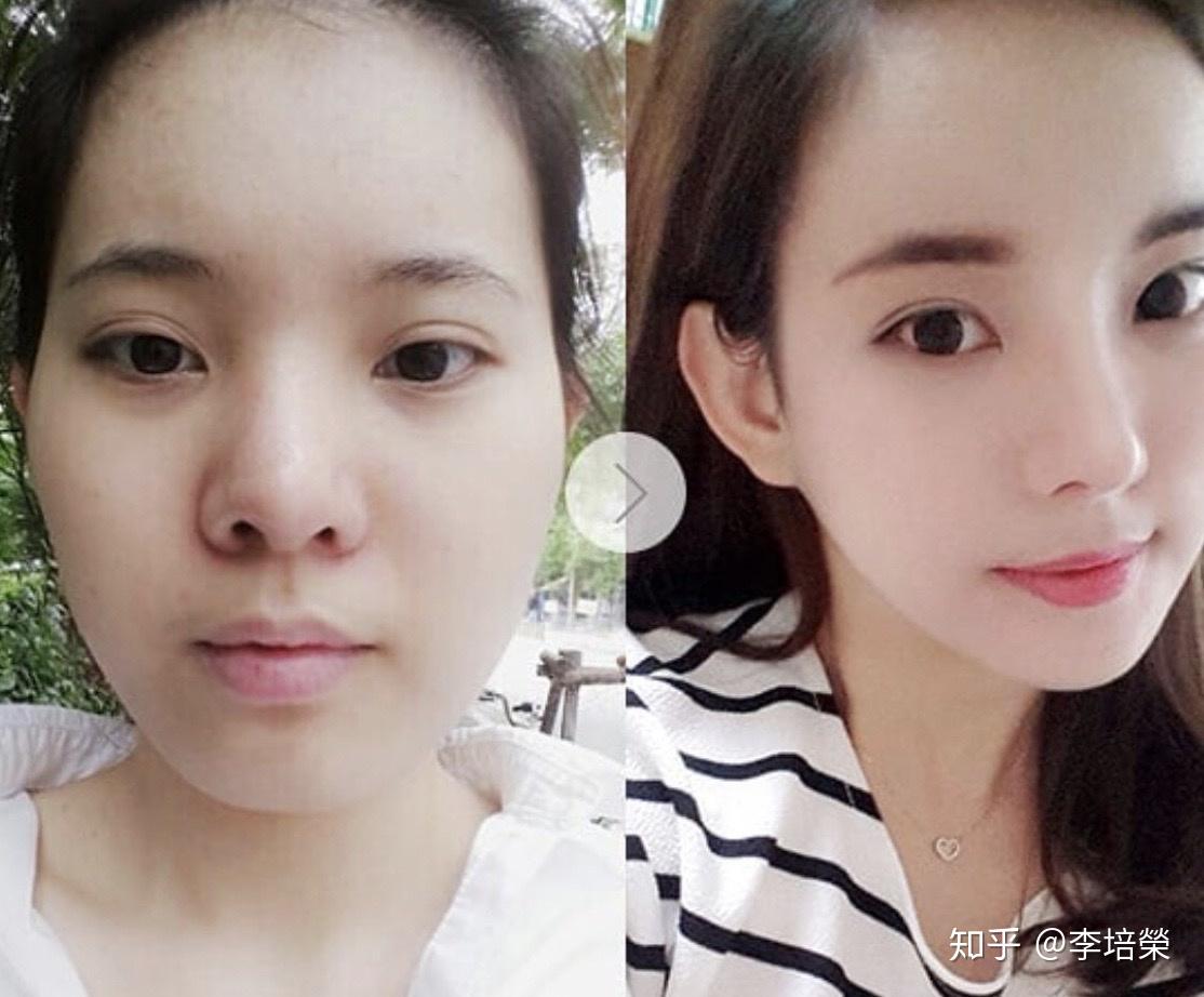 轮廓针和瘦脸针的区别