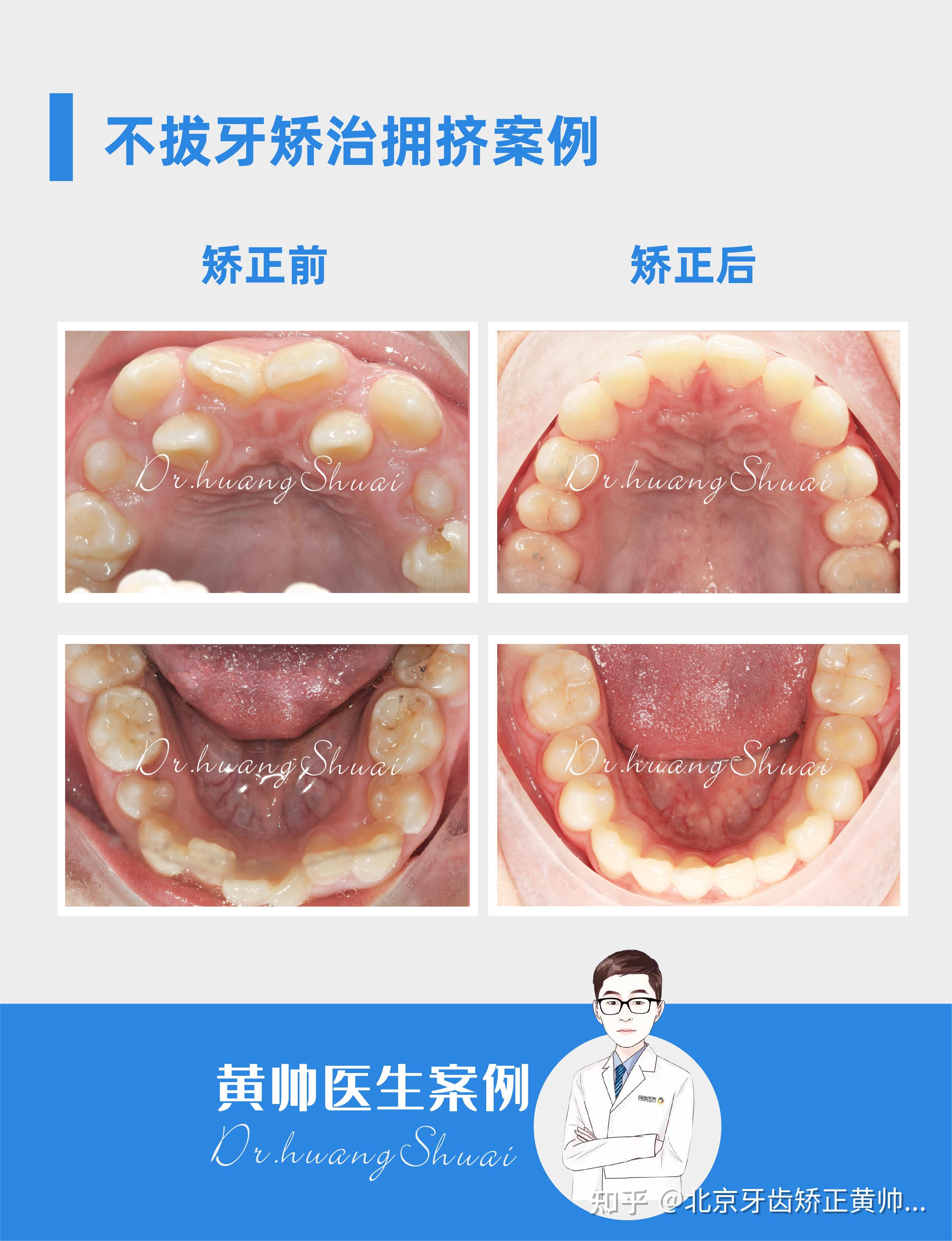 兒童替牙期牙齒擁擠擴弓磨牙遠移收穫整齊牙齒