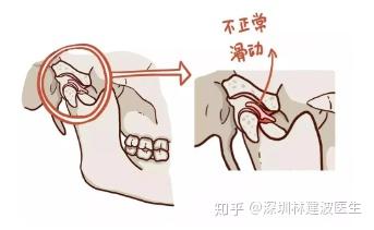 为什么打个哈欠下巴也能脱臼?甚至嘴巴闭不上了,连饭都不能吃.