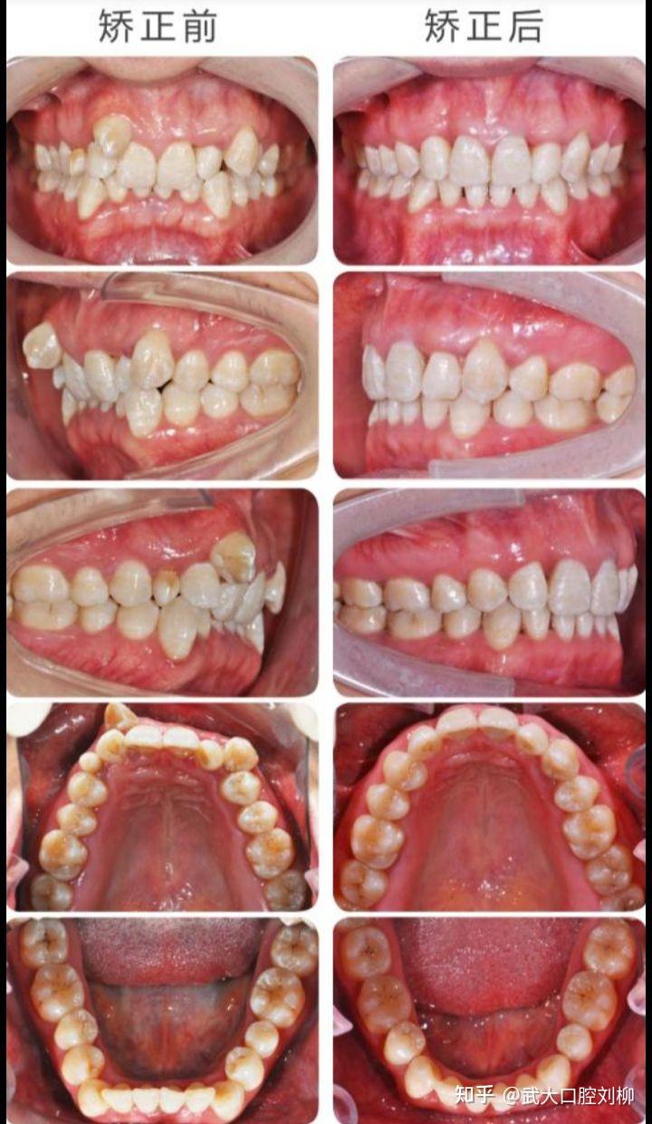 正畸9张照片图片图片
