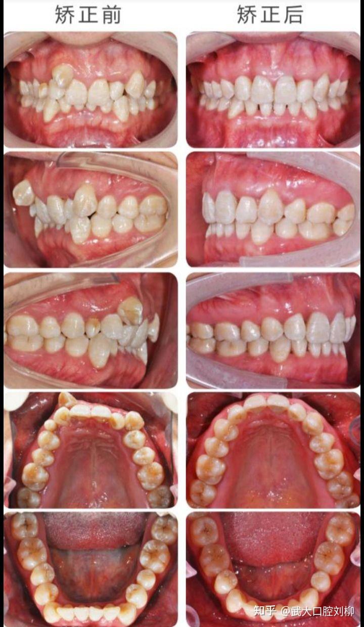 想去做正畸有哪些做过才知道的事