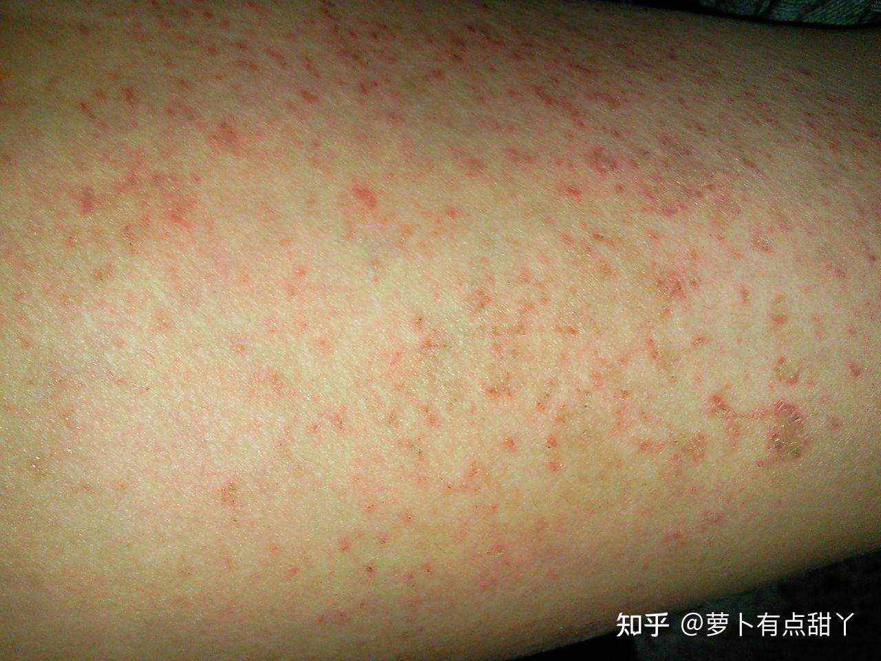 有没有做过激光脱毛的女生?能否交流一下?