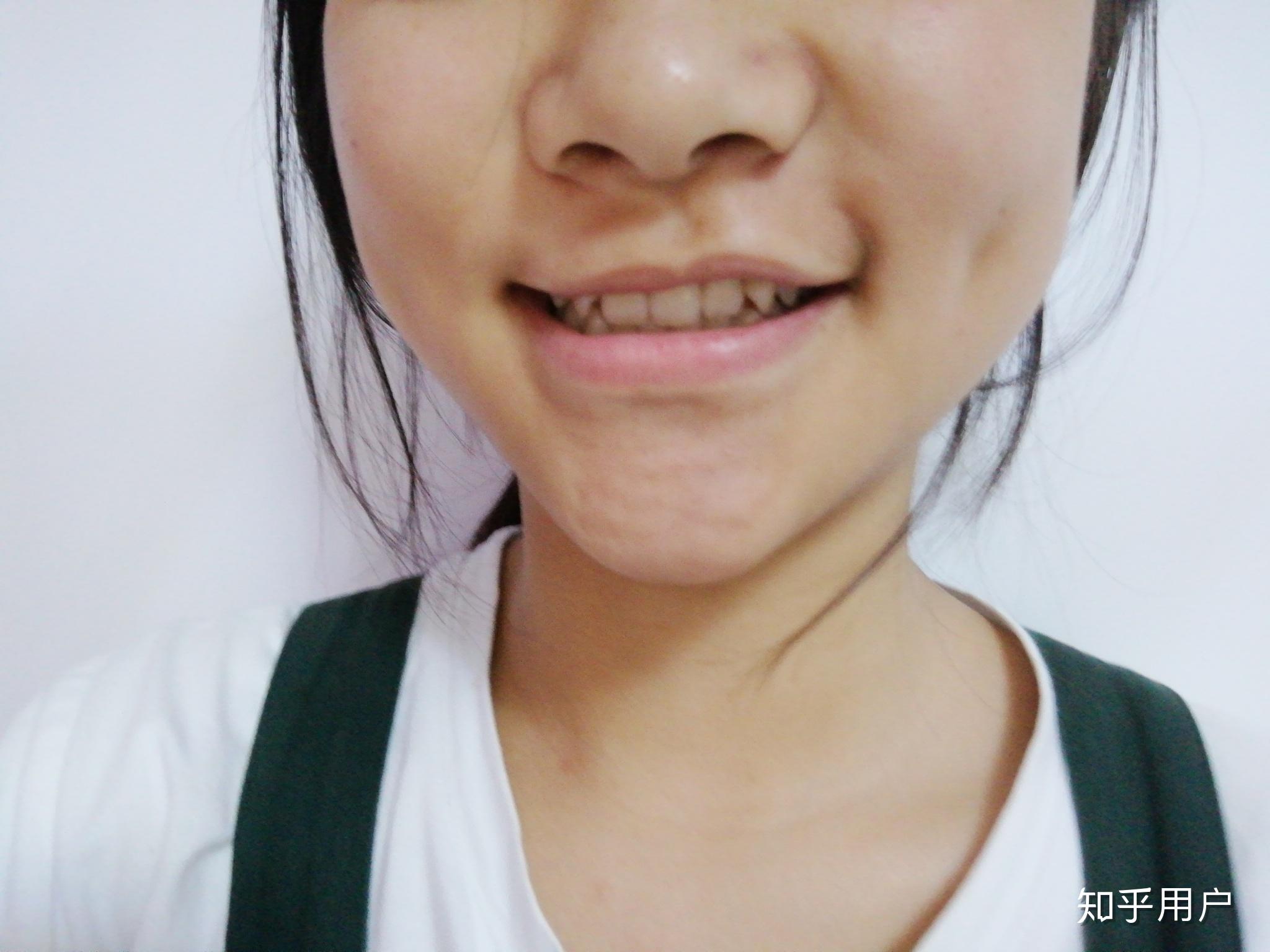 嘴角完全不对称要怎么矫正