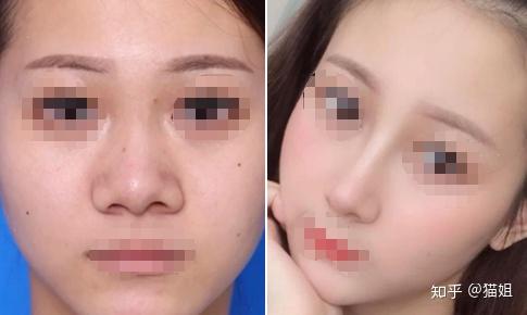 塌鼻梁有什么好的拯救方法