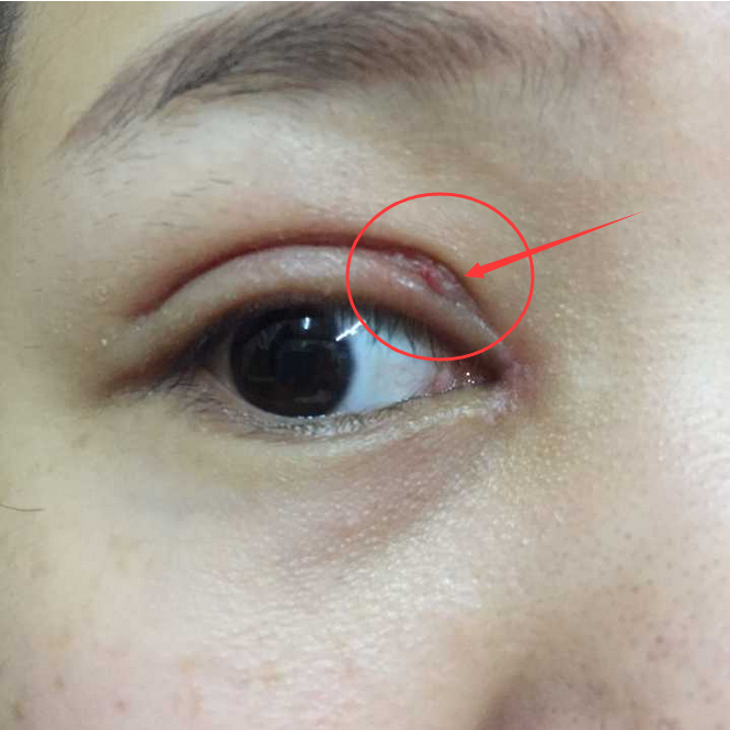 双眼皮第15天 这是增生还是手术缝合问题? - 知乎