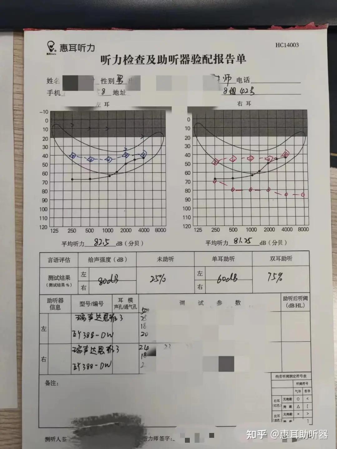 六十多歲混合性耳聾驗配瑞聲達助聽器恩雅系列案例分享 - 知乎