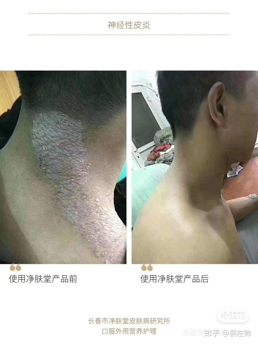 神经性皮炎 - 知乎