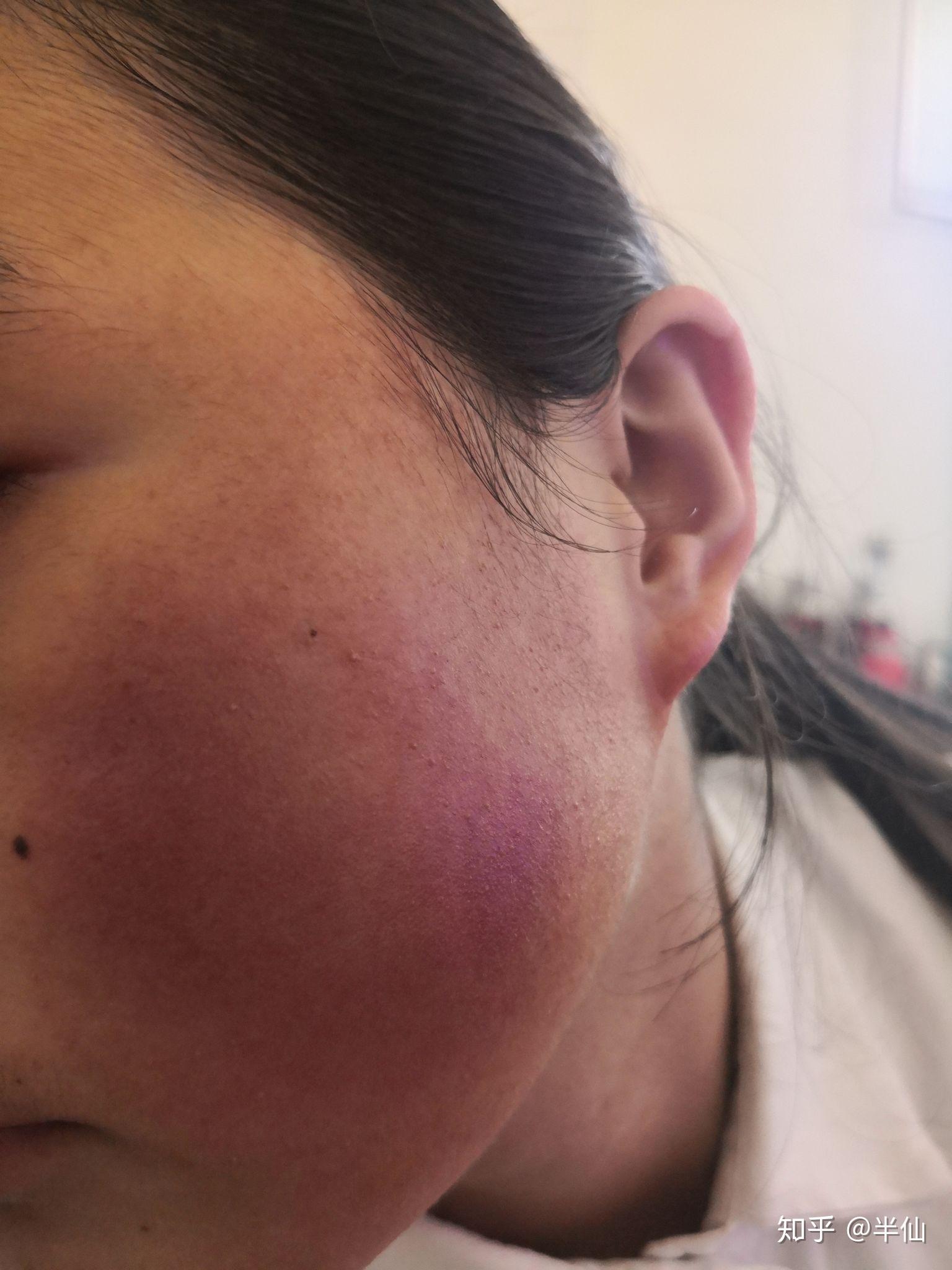 皮肤敏感泛红怎么办