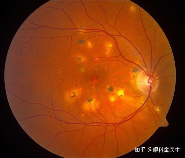 视网膜色素变性新突破图片