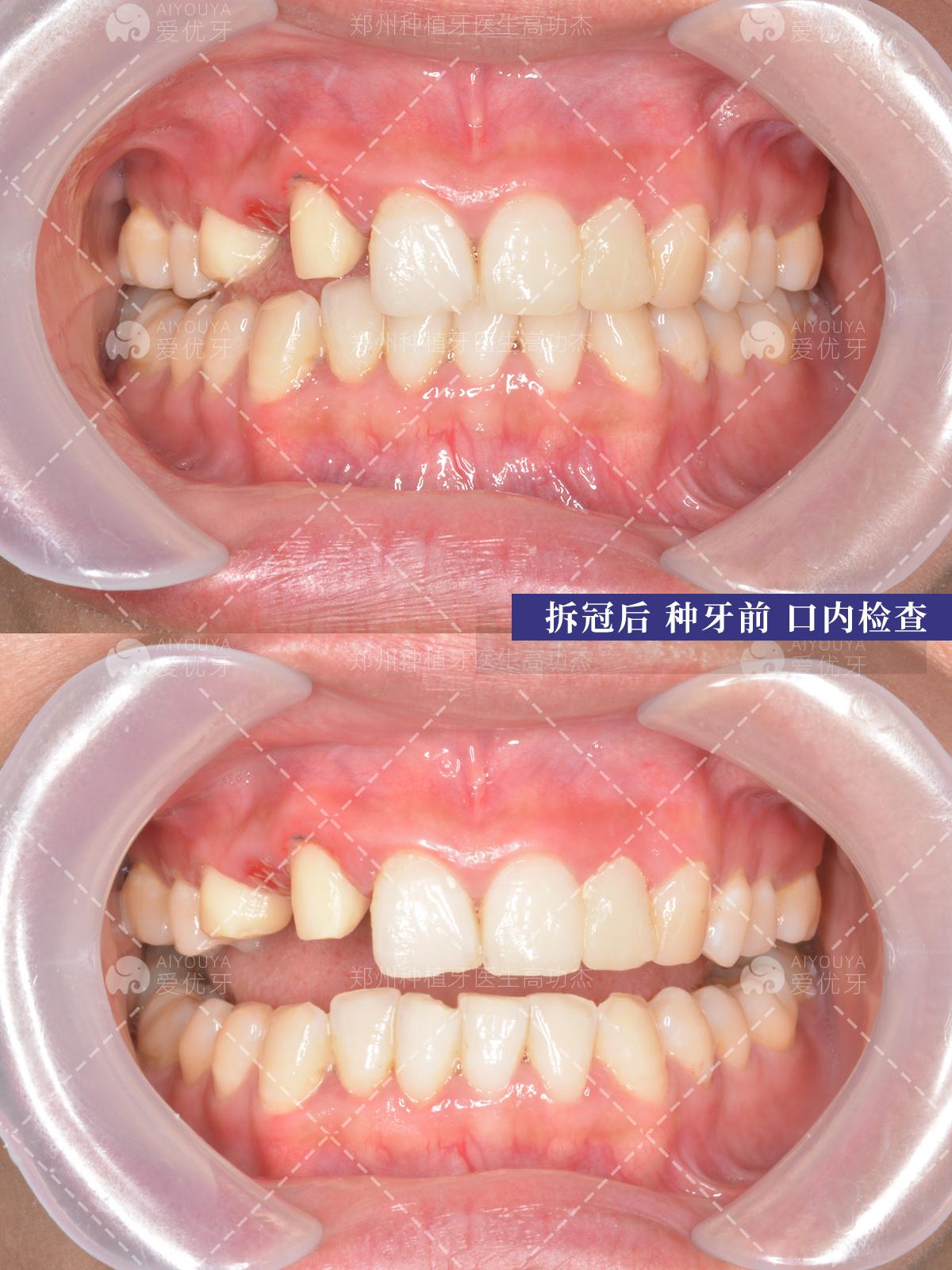 牙科临时牙 临时冠口腔烤瓷牙冠牙片牙贴面前后牙齿科材料-阿里巴巴