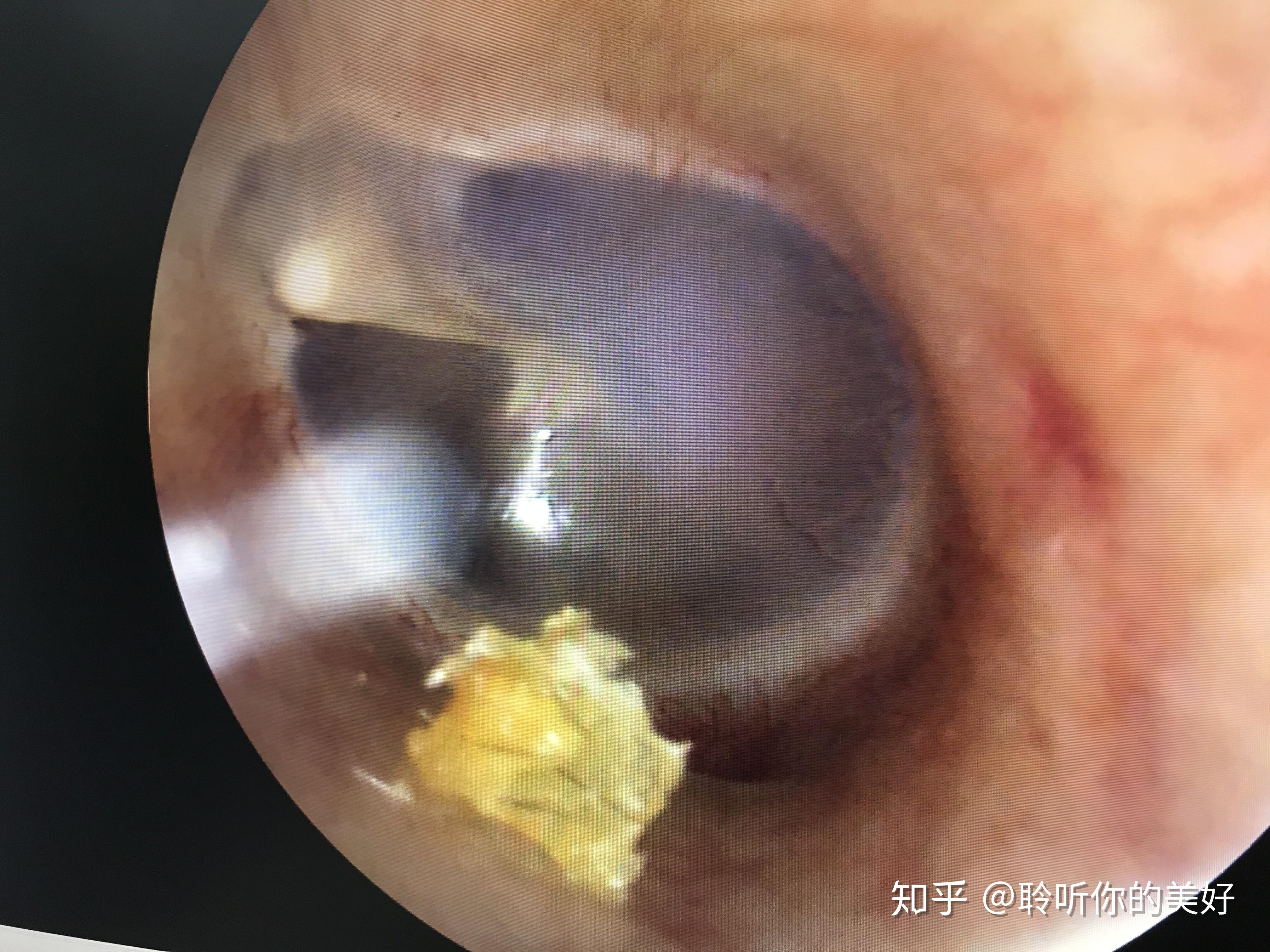 鼓膜会把耳道给完全封闭吗是不是什么东西都进不去了