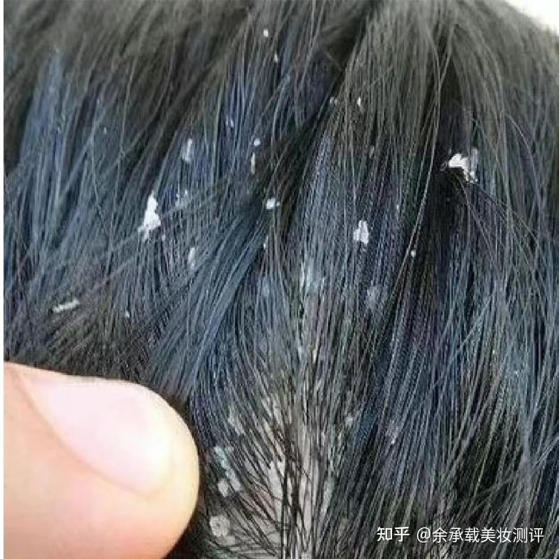 头屑头痒用什么洗能去屑止痒?洗发水去屑止痒推荐 - 知乎