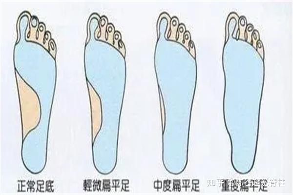 为什么会出现扁平足？扁平足的危害是什么？ 知乎