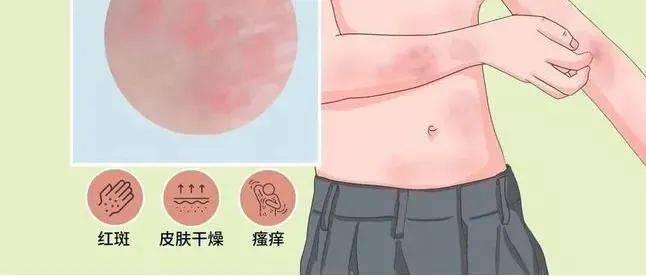 特应性皮炎和湿疹有什么区别？从五个方面区分！ - 知乎