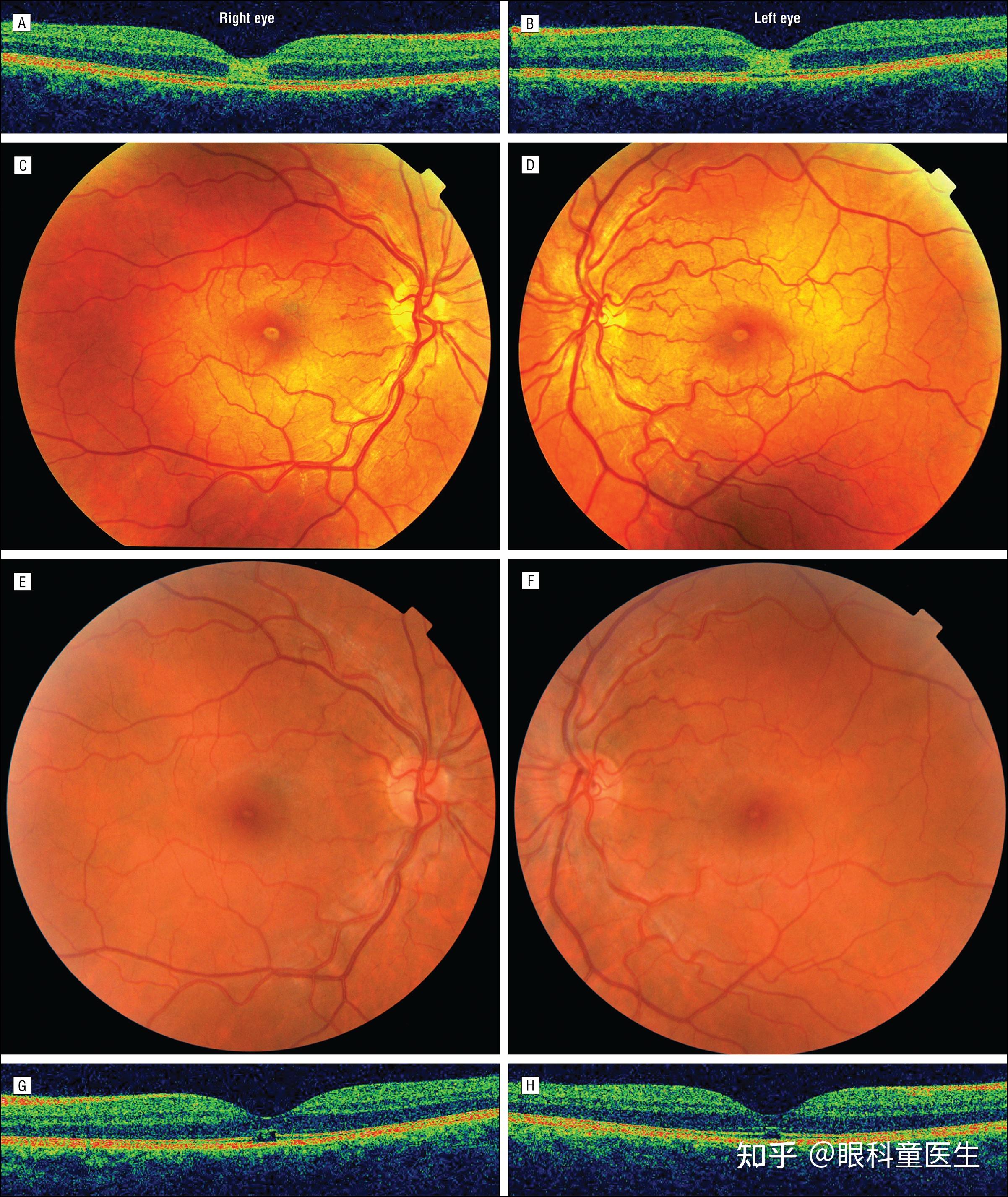 与系统性疾病相关的视网膜病变——2、糖尿病视网膜病变 - 知乎