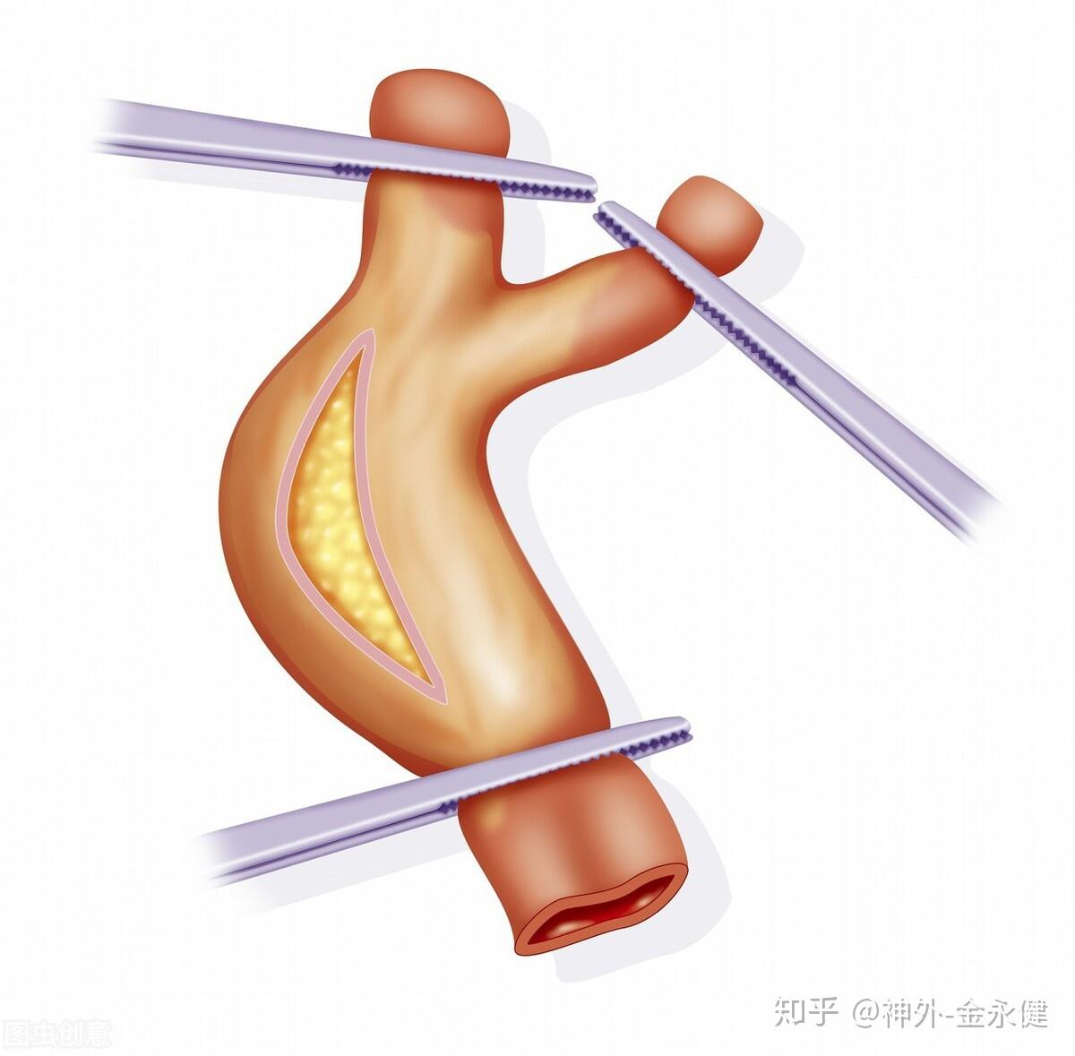 剝脫術和支架手術都是治療頸動脈狹窄的手術方式.