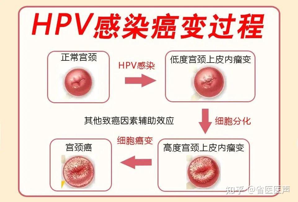  哪种hpv病毒最严重女性(一旦得了hpv最明显的征兆)