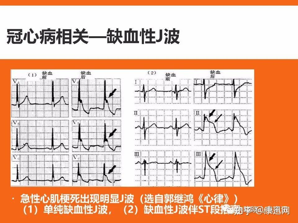 及时预测心脏猝死风险!心脏猝死预警心电图分析,建议收藏! - 知乎