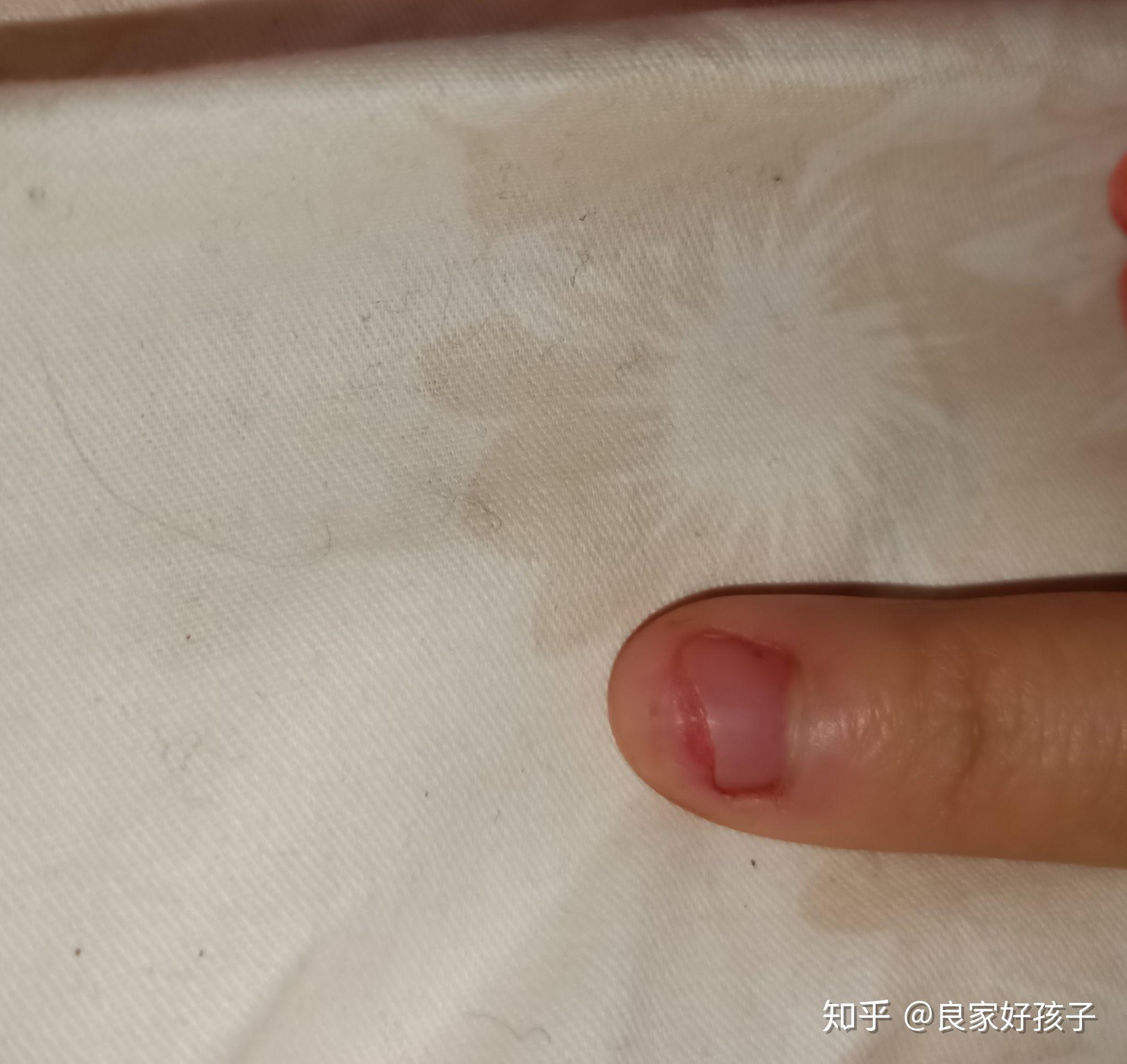 指甲缝干痒脱皮如图