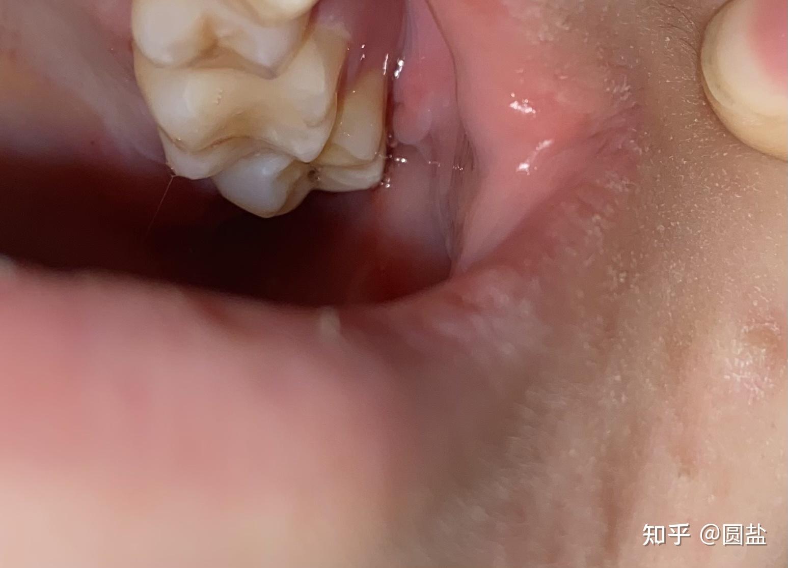 拔完智齿感觉前面一颗牙歪了? - 知乎