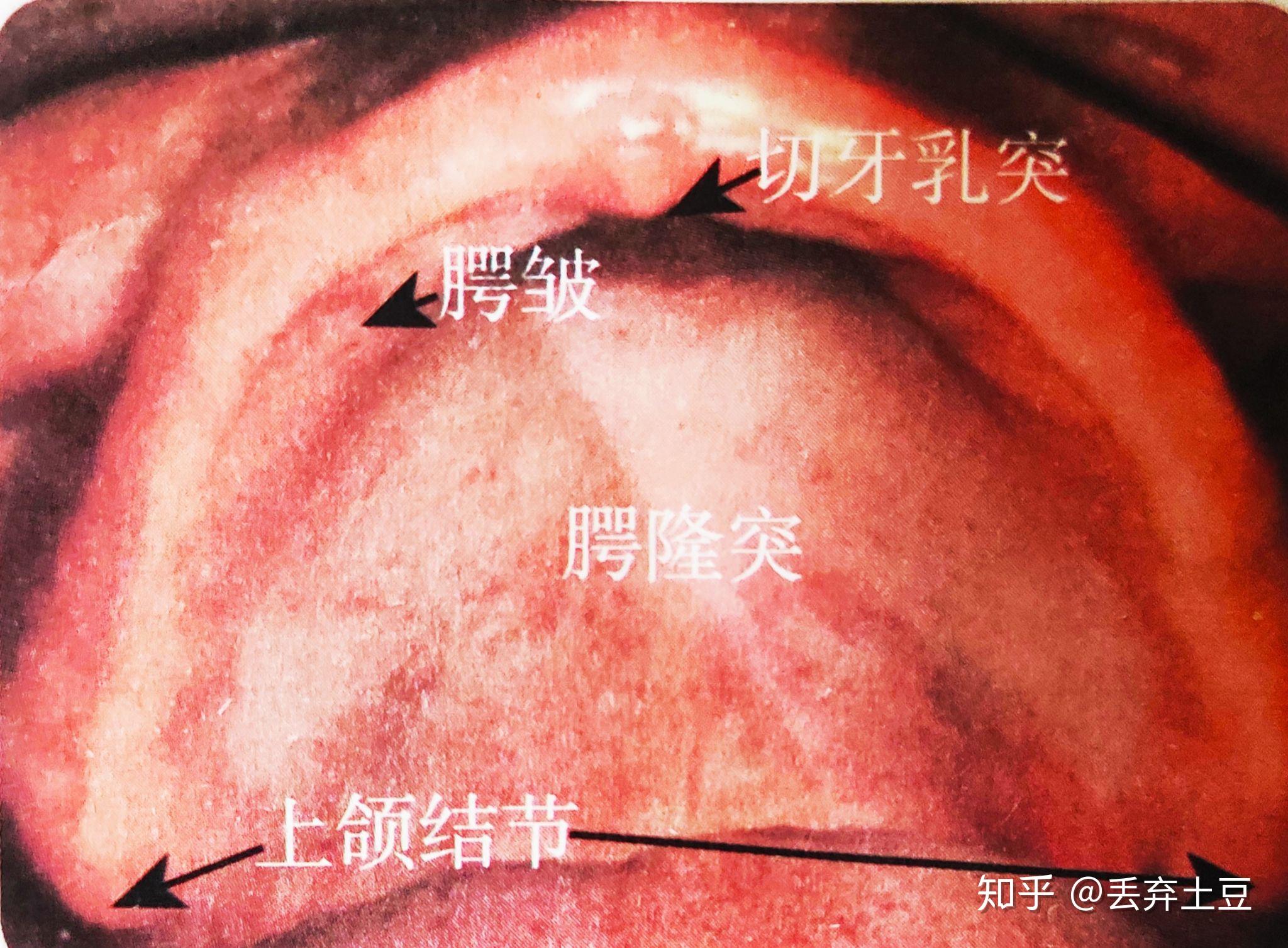 舌侧隆突的位置图片图片