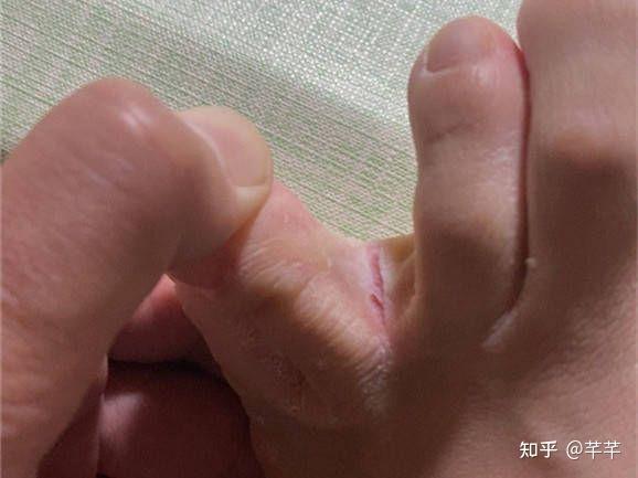 脚趾缝痒溃烂型脚气常见的这个3天改变