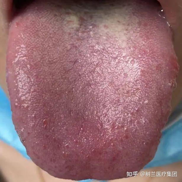 左图一为小雅治疗前,舌带齿痕,舌苔红紫,气血瘀滞,舌质纹理粗糙,带