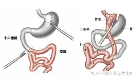 手术减肥_减肥手术有什么危害_减肥手术医保能不能报销