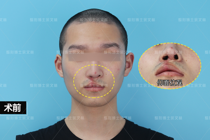 整整10次唇鼻畸形修复!这次究竟能画上圆满句号吗? - 知乎