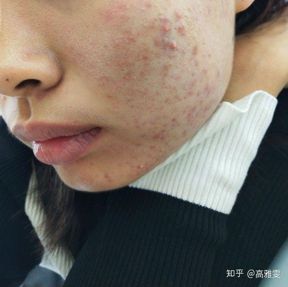 脸上痘痘很多毛孔堵塞严重每一个毛孔都可以挤出黄白色的油脂粒怎么办