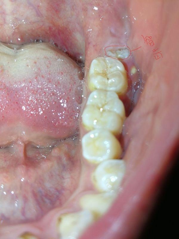 牙龈长了脓包,要不要去医院治疗? - 知乎