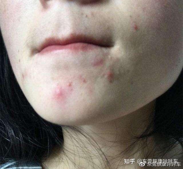 痘痘会不会传染 zhuanlan.zhihu.com