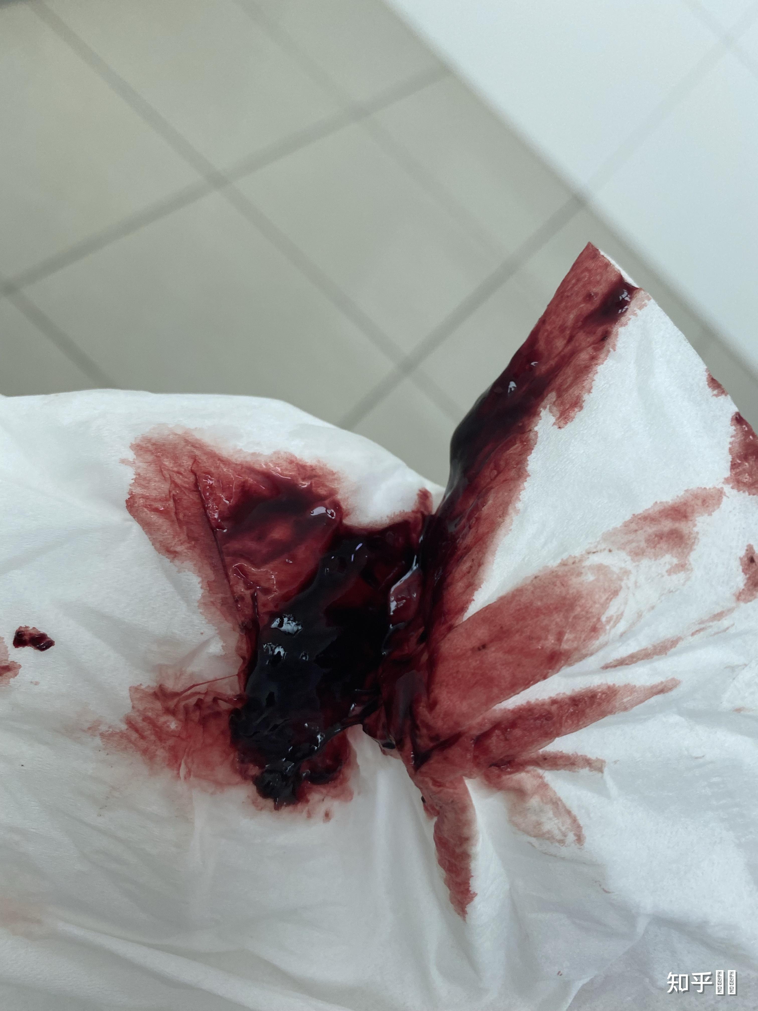 药流后20天有14mm38mm残留医生建议清宫我想月经后带出有希望吗