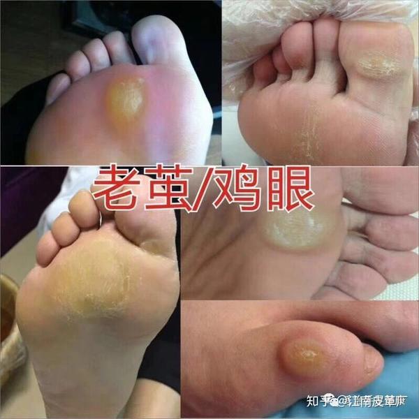 各種腳部問題皮膚病案例對照表