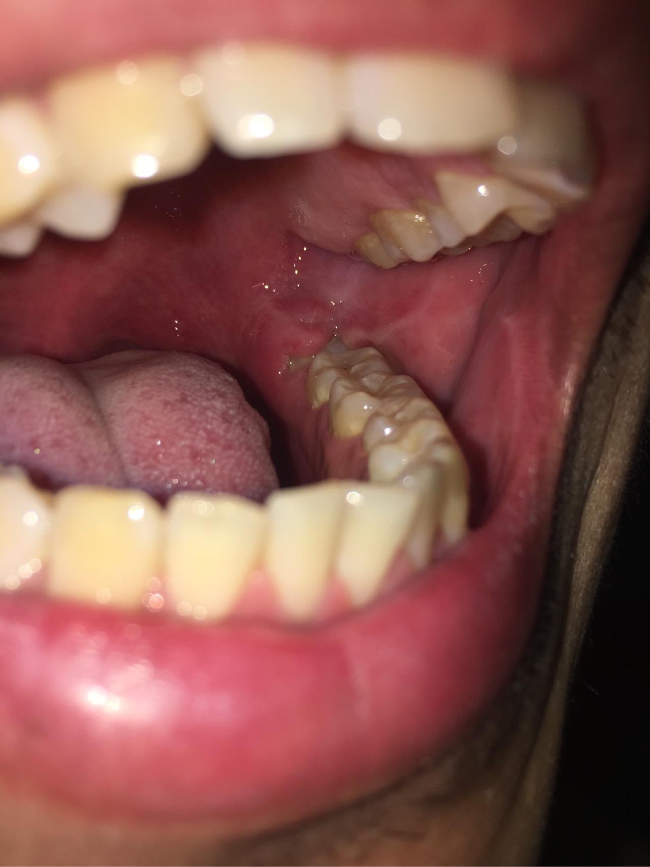 百分百!智齿发炎肿痛怎么缓解"如何快速"-第2张图片-杰泰网