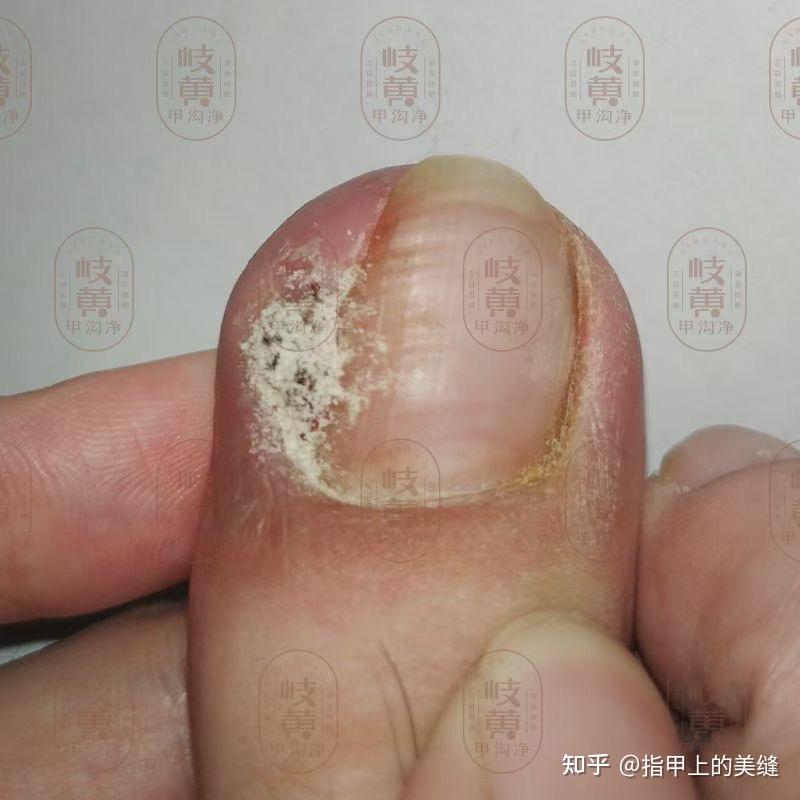 脚趾甲沟炎长肉芽怎么处理?不修脚可以治好吗