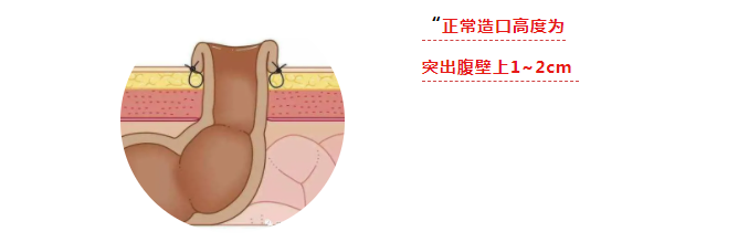 造口周围皮肤凹陷,造口底盘粘贴不牢易翘边,该如何护理? - 知乎