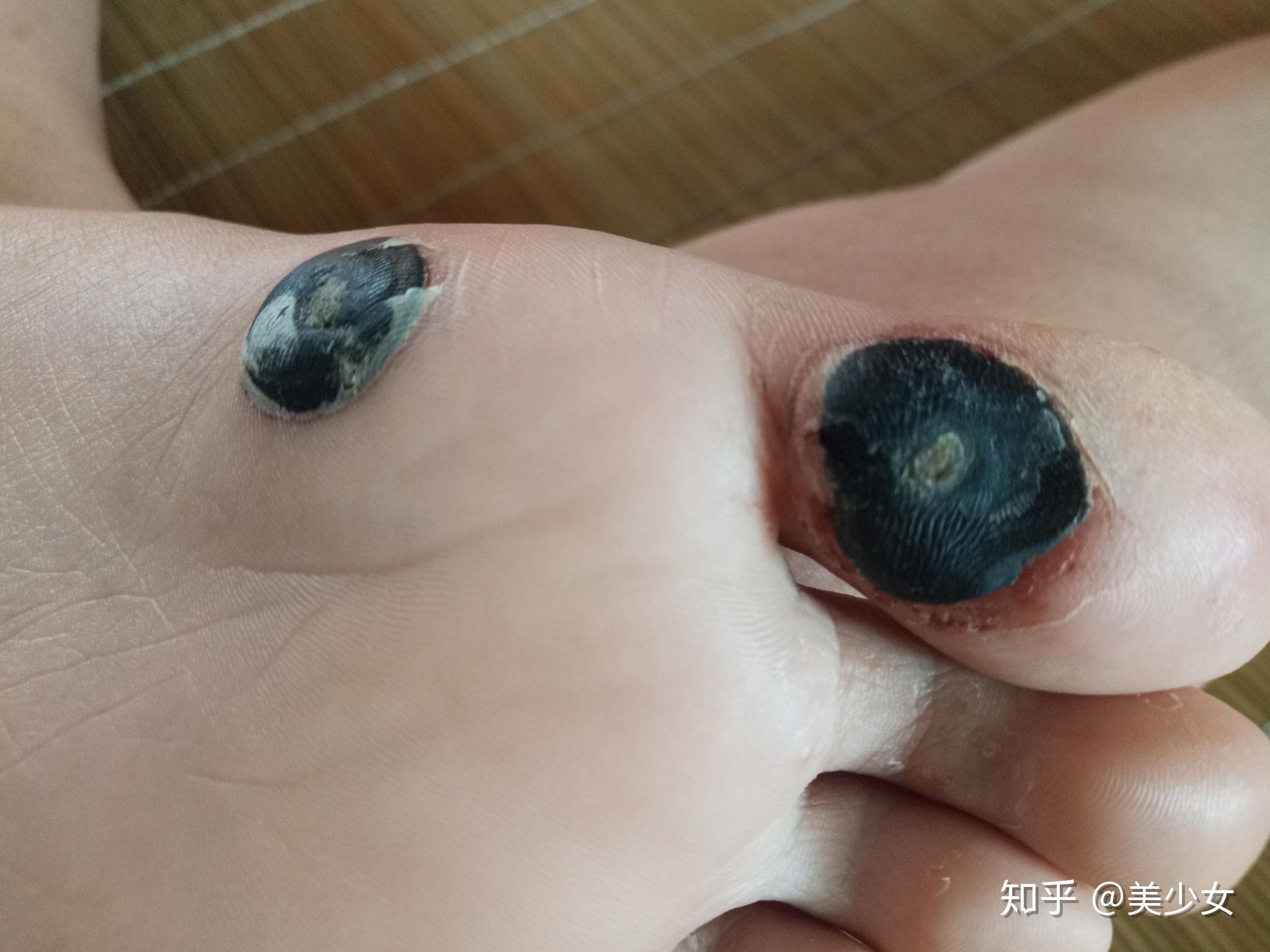 液氮冷冻治疗后手指上出了血泡而且越来越大该怎么办