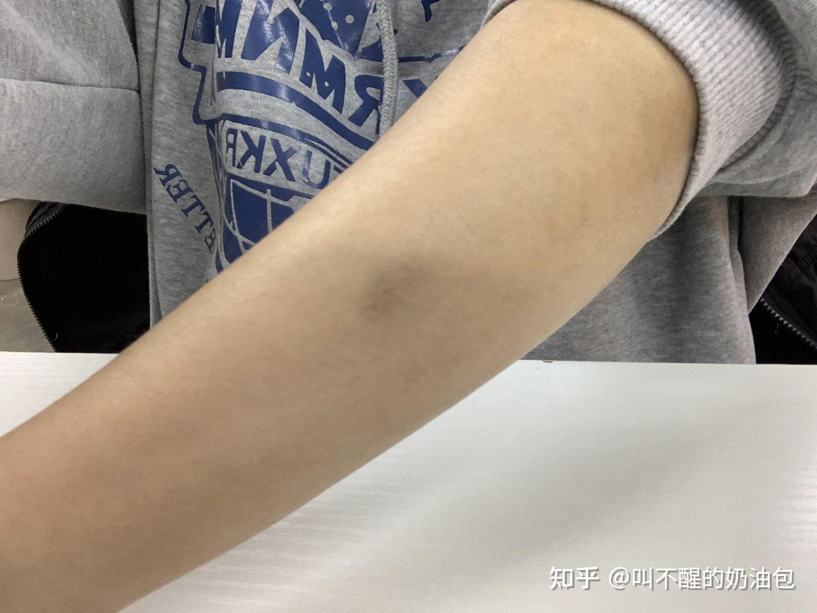 摔伤的,怎么去除这些疤痕? - 知乎