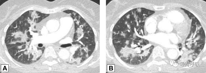 图片[3]-CHEST综述：机化性肺炎的诊断流程（临床-影像-病理特征相关性） | 每周呼吸-每周呼吸